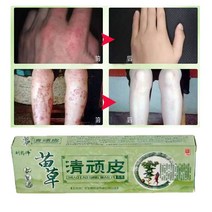 피부염 및 습진 비밀 피부염을 위한 건선 크림 피부 회복 손발톱 진균증 치료 스킨 케어, [01] 옵션 1