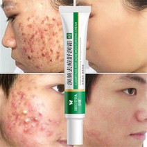 CAICHEN 효과적인 여드름제거 크림 허브 여드름 스팟 오일 컨트롤 여드름 크림 스킨케어 화이트닝 모이스처라이징 페이스 젤 스킨케어 20g|얼굴 셀프 태너, 20g, 1개