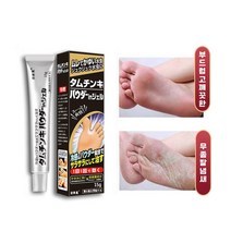 ANLAIHUI 무좀약 무좀 연고 발톱무좀치료방법 발톱무좀약 발톱무좀 치료 (습진 가려움 악성체취 발냄새 발각질 완화), 15g