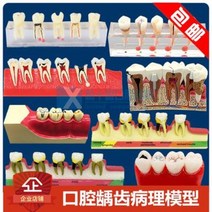 치아모형 재료상 입모형 모양 구강수업모델 치과와구 폐쇄모델 치주병, 02 치주 분류 모델(소프트 잇몸) 4010