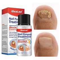손발톱 무좀 치료제 진균 리페어에센스 발톱 케어제 발톱연화, 20ml*2개, 2개