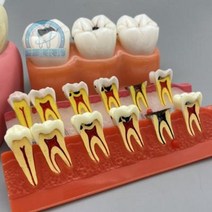 치아모형 재료상 입모형 모양 치과모델 4배 6배, 01 4배 충치 분해