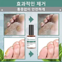 C&R 발가락 티눈 치료 편평사마귀 발바닥 티눈 제거, 10ml