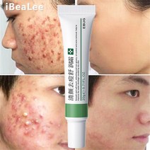 여드름크림 피부트러블 치료제 여드름흉터크림 청소년 성인용 스킨케어제