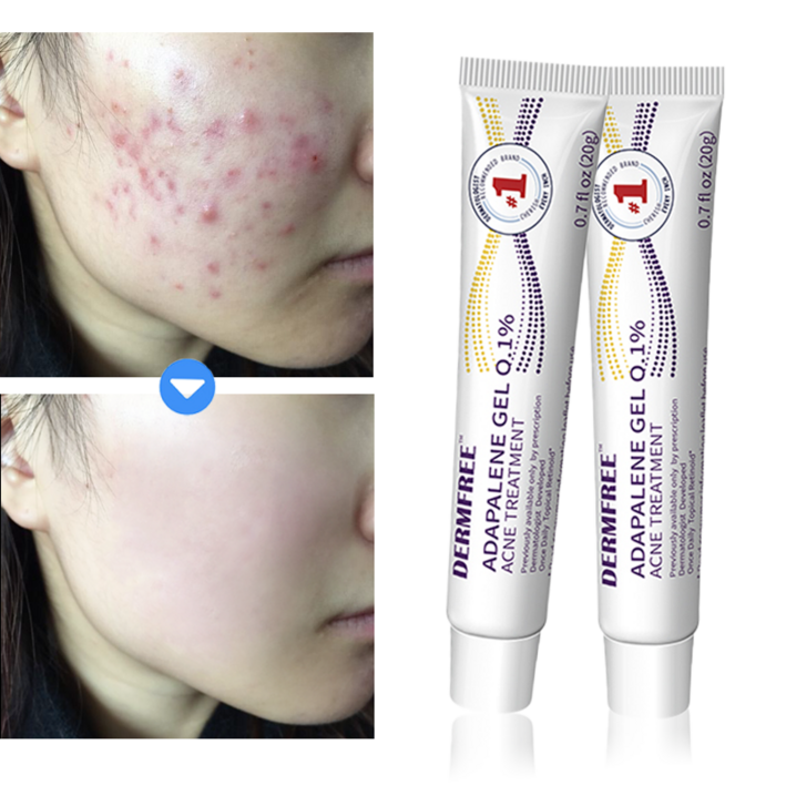 DERMFREE 여드름 제거 리페어 크림 스팟 케어 문제피부 자국 모공 진정 피지케어 연고, 2개, 20g DERMFREE 여드름 제거 리페어 크림 스팟 케어 문제피부 자국 모공 진정 피지케어 연고, 2개, 20g